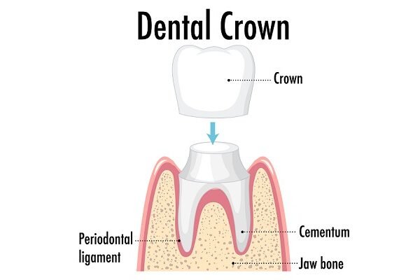 Crowns
