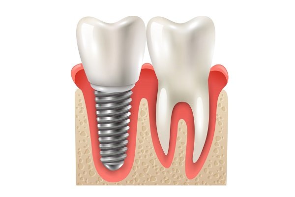 Dental Implants