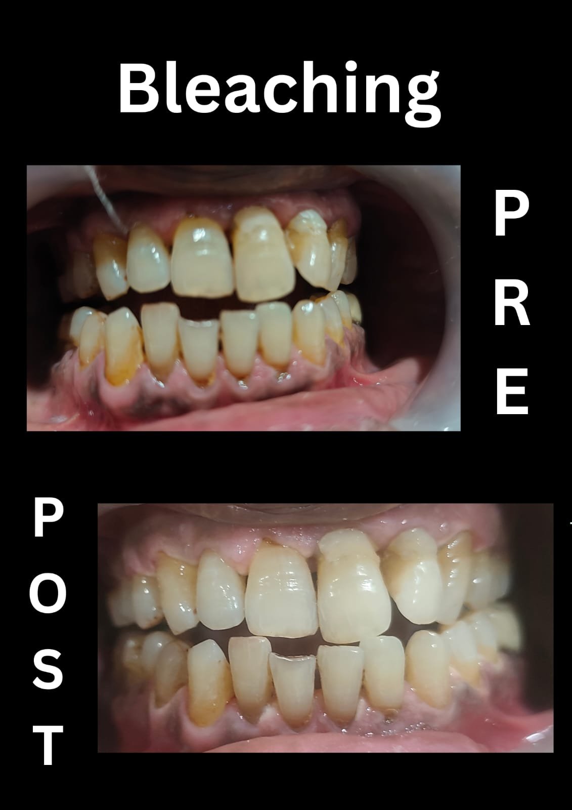Bleaching